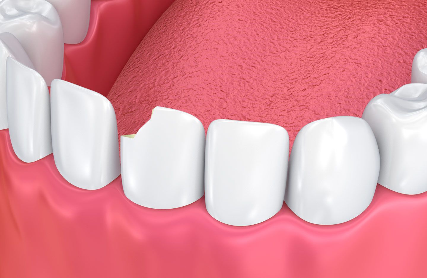 Chipped tooth in need of dental bonding.